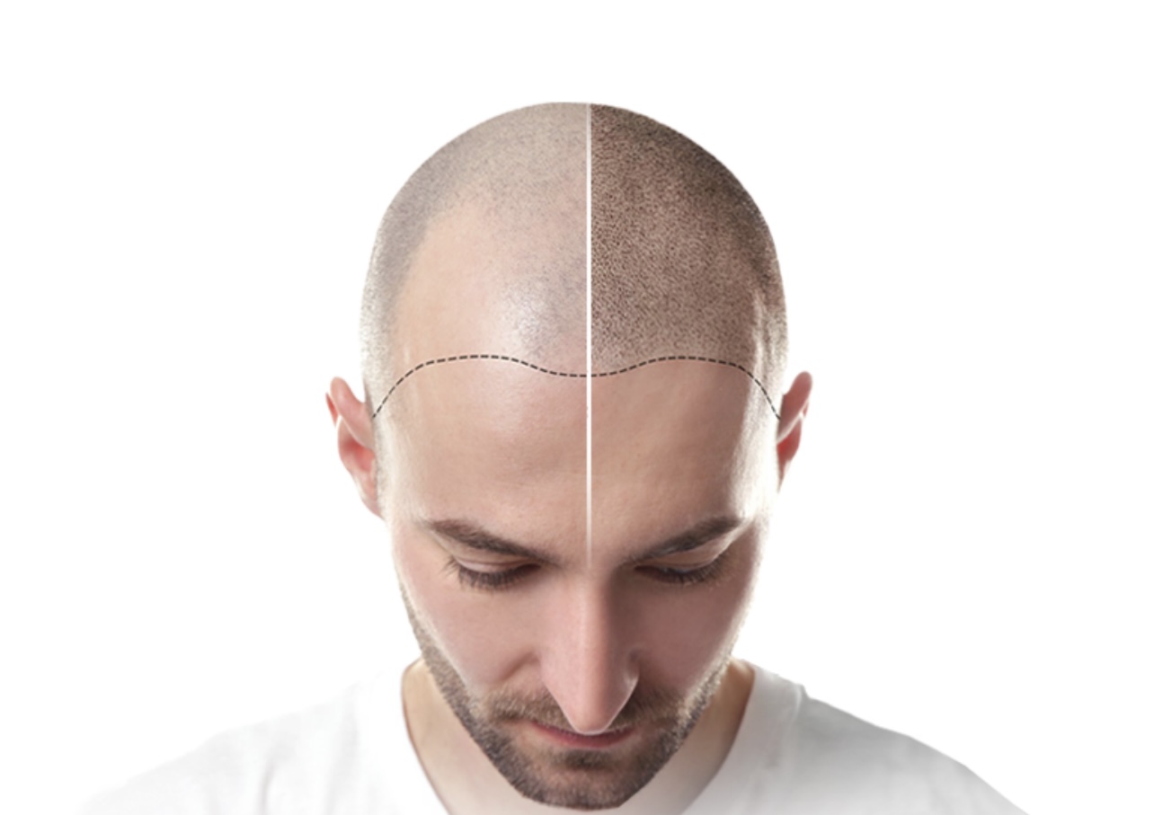 Hair Implant KEEP technique demonstration